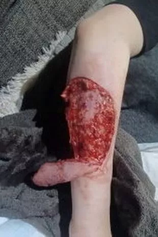 7岁的女儿被宠物狗咬伤,手臂上的皮肤脱落,妈妈惊恐不已